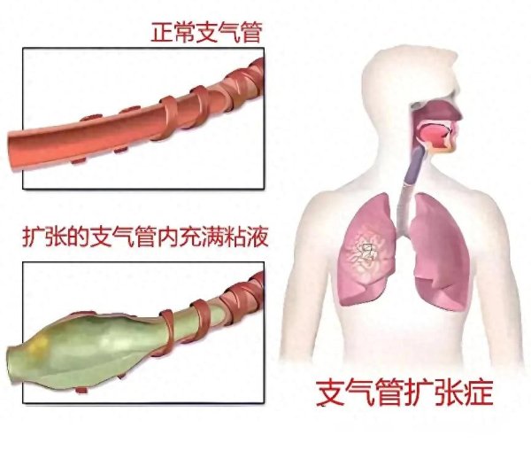 行医50年, 用这张化痰祖方帮无数支扩患者解决了痰根!